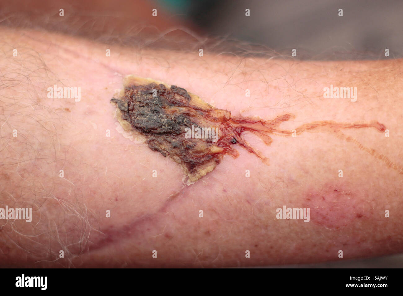 Man's leg with scar tissue and a large weeping scab Stock Photo