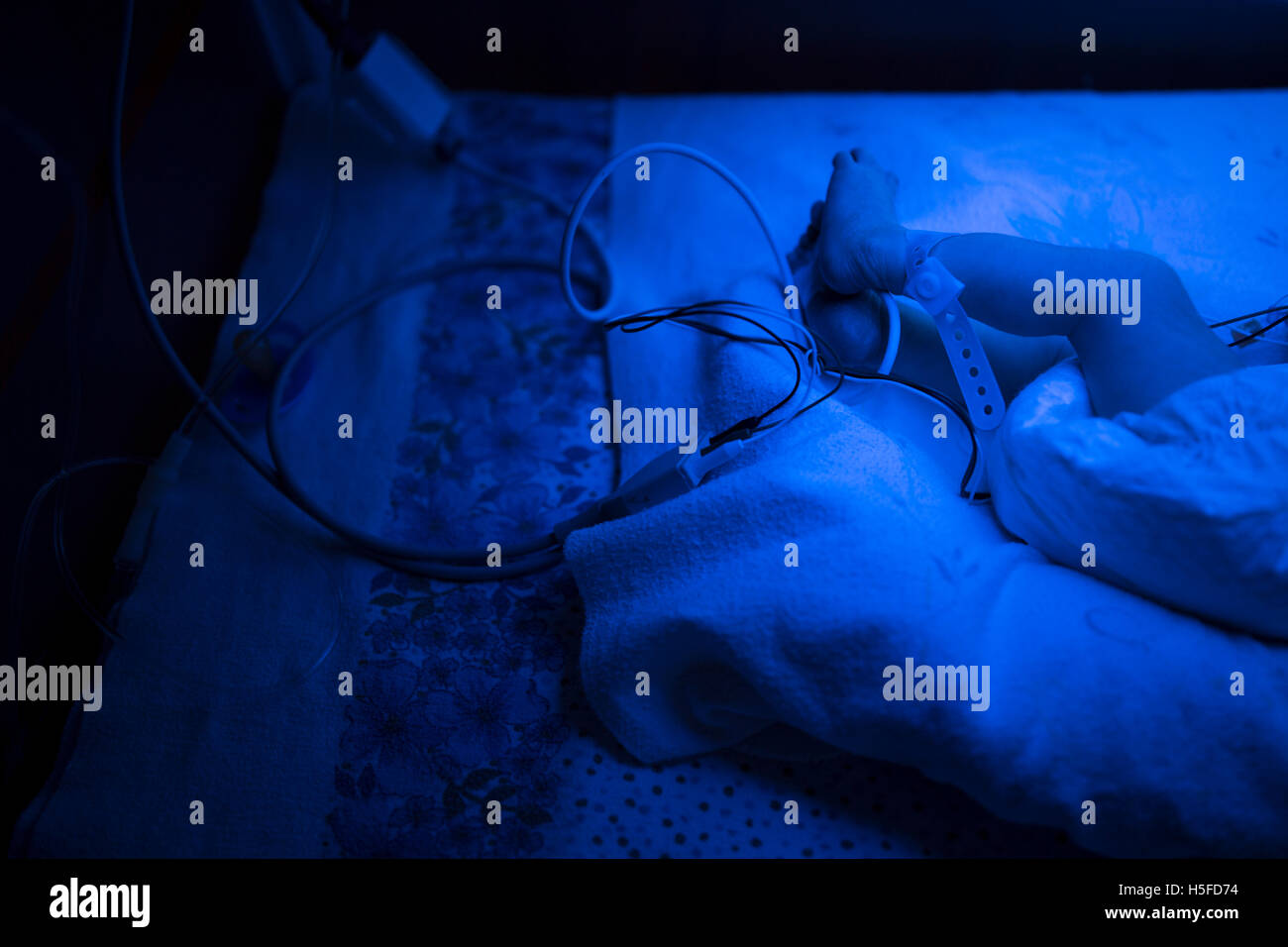 Treats jaundice hires stock photography and images Alamy