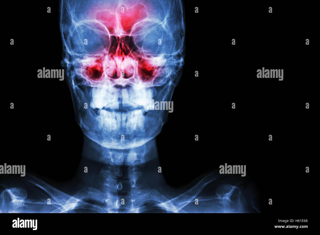 Sinusitis. film x-ray skull AP ( anterior - posterior ) show infection and inflammation at frontal sinus , ethmoid sinus , maxil Stock Photo