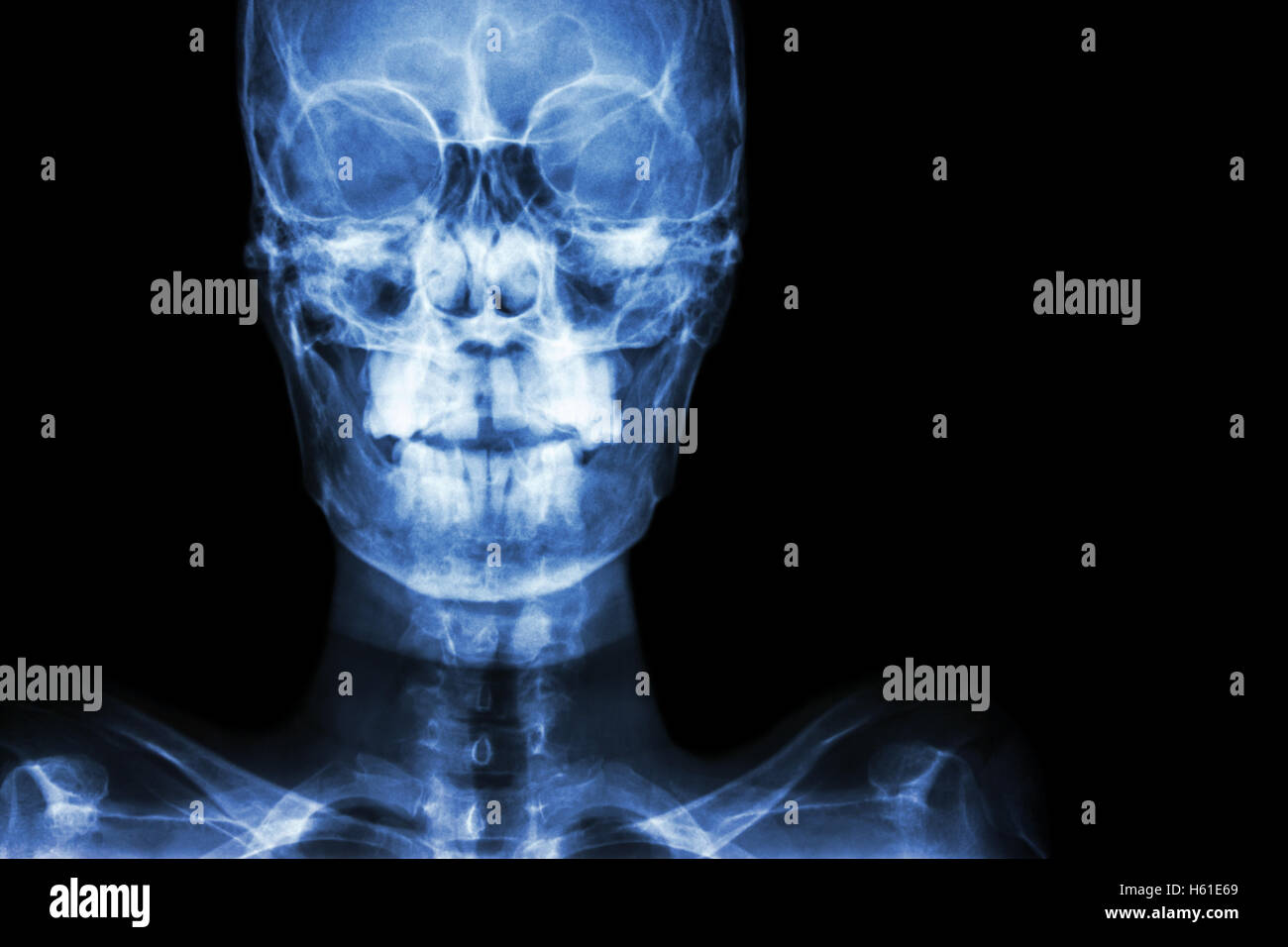 film x-ray Skull AP : show normal human's skull and blank area at right side Stock Photo