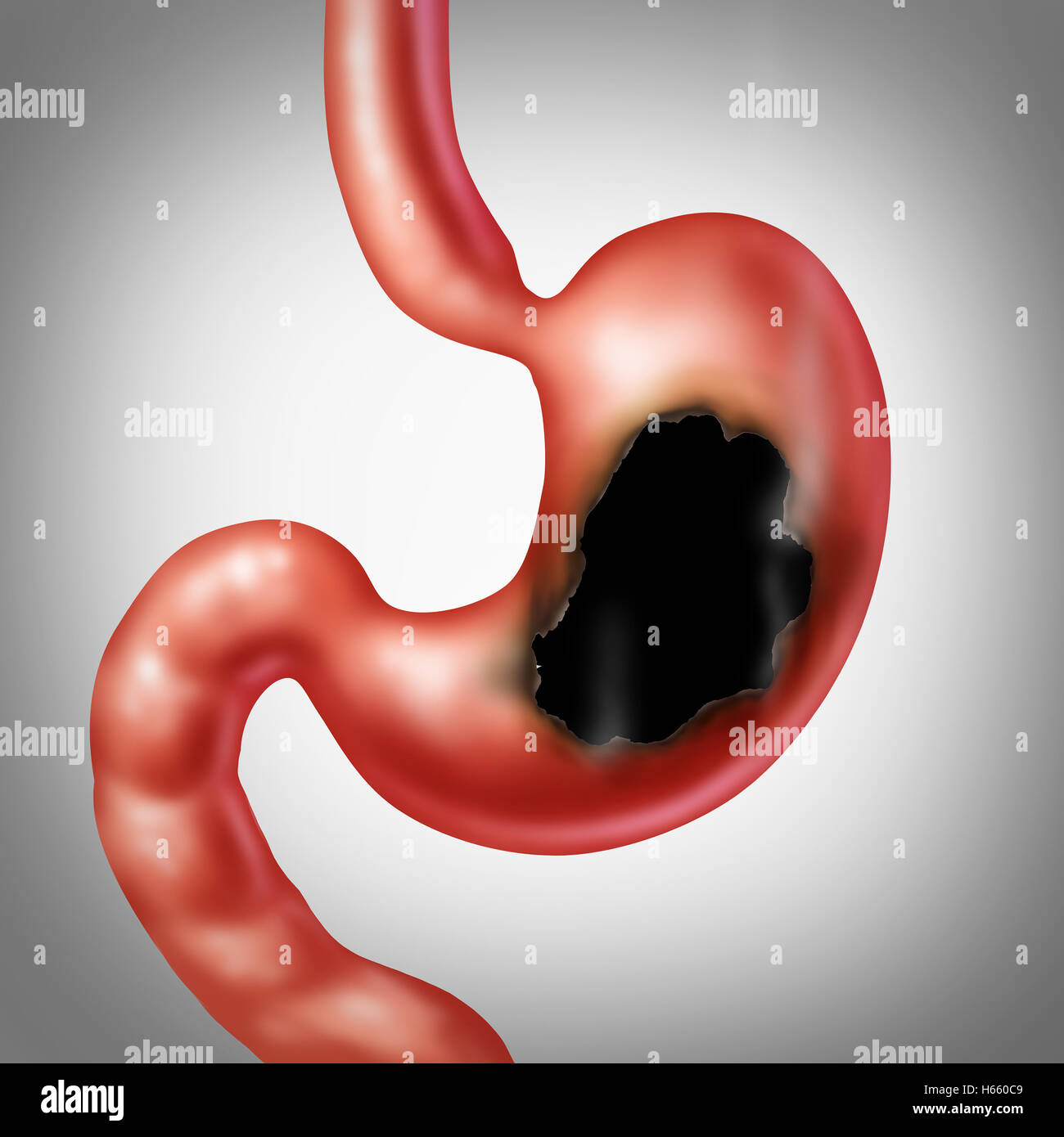 Stomach ulcer medical concept and burning indigestion pain in the digestive system with a medical illustration of the human abdomen organ with a hole and a burn with smoke as a health care symbol in a 3D illustration style. Stock Photo