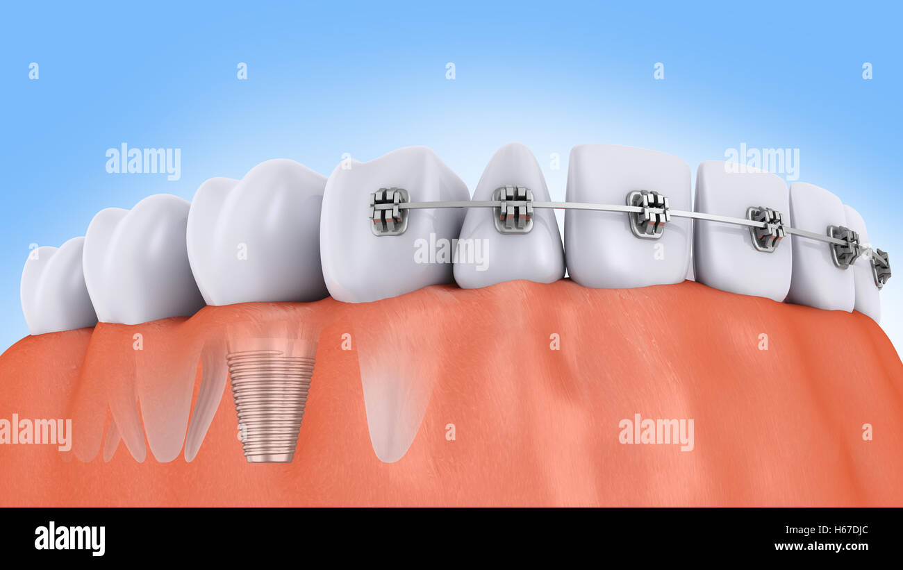 a teeth with braces and dental implants, 3d render Stock Photo - Alamy