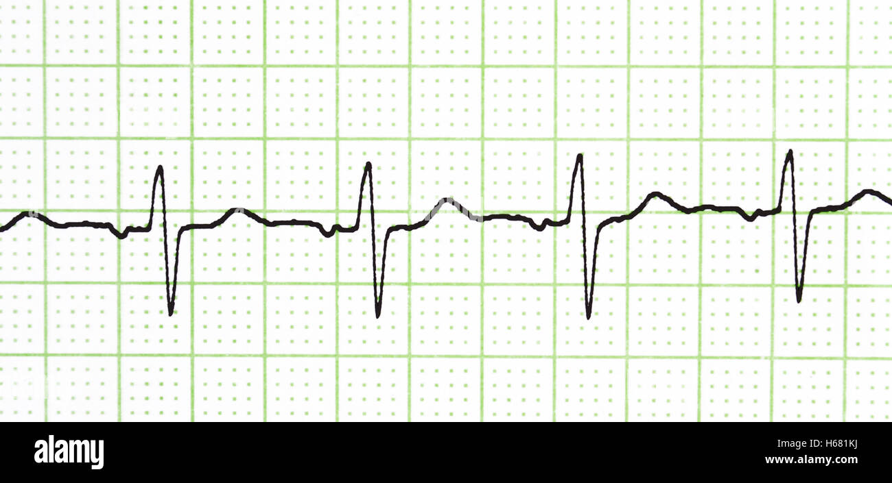 Electrocardiogram test hi-res stock photography and images - Alamy