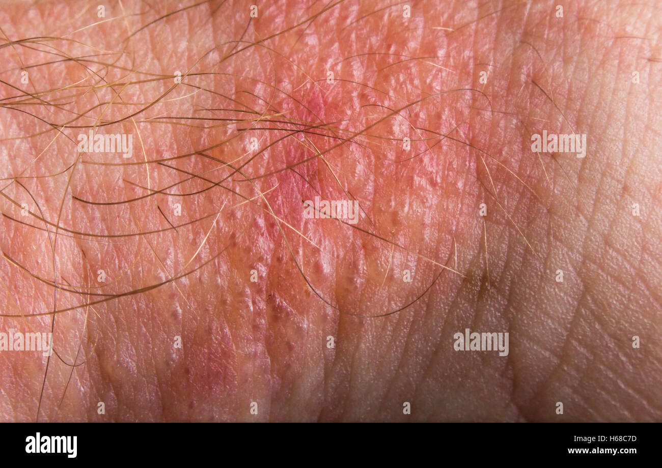 Close up macro poison ivy rash blisters on human skin Stock Photo