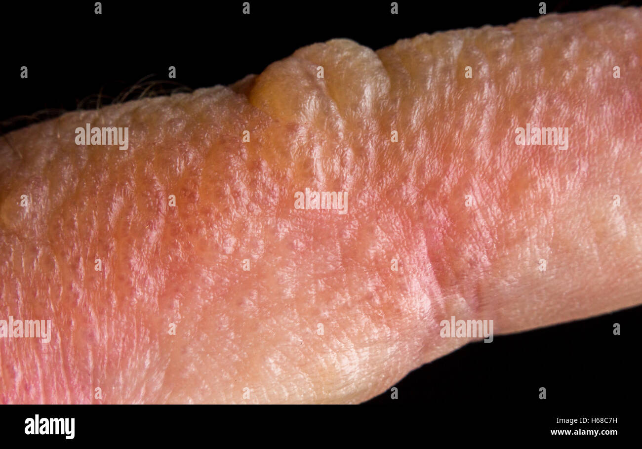 Close up macro poison ivy rash blisters on human skin Stock Photo