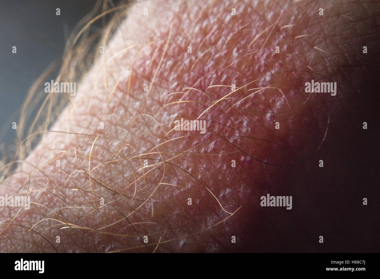 up macro poison rash blisters on human skin stock photo royalty free image 124345749 poison rash stock photos poison rash stock images alamy up macro poison rash blisters on human skin stock photo royalty free image 124345749 poison rash stock photos poison rash stock images alamy