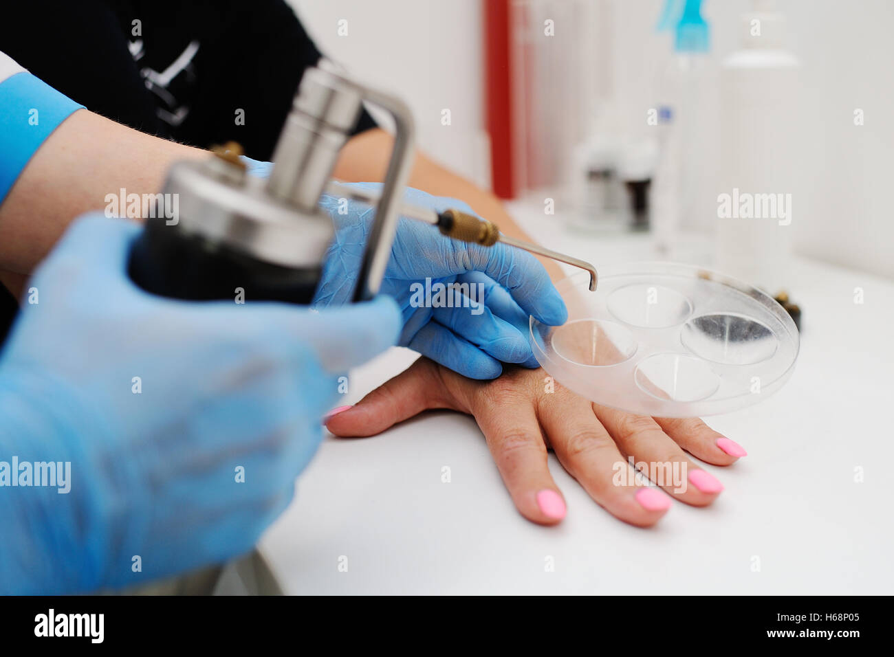 Freezing skin cancer hi-res stock photography and images - Alamy