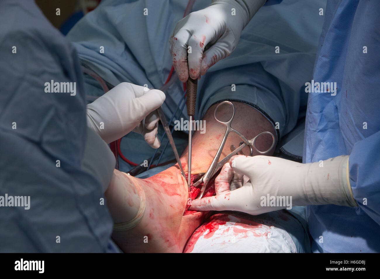 Open reduction and internal fixation of ankle-Ankle operation Stock Photo
