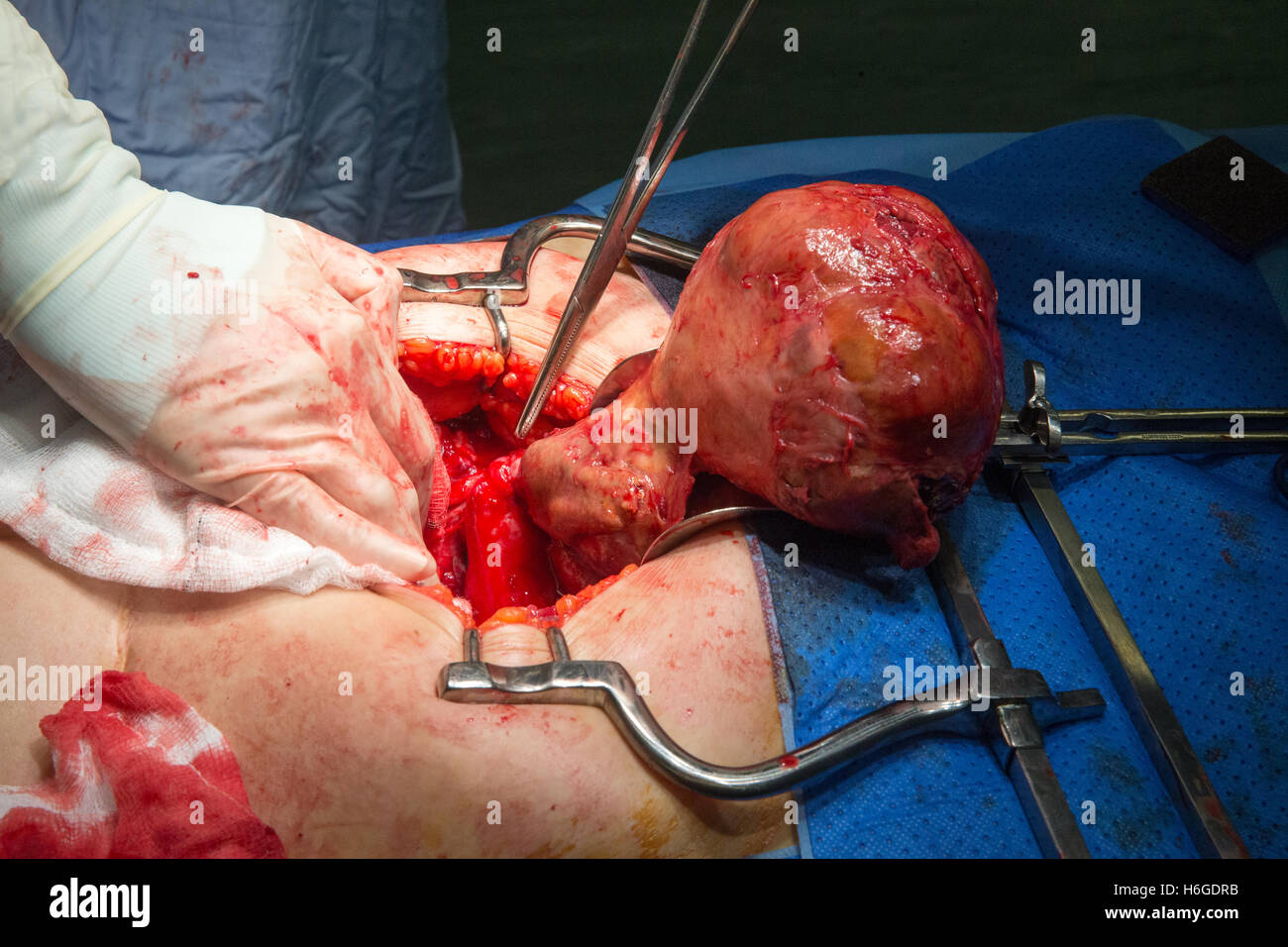 A twisted Fibroid is revealed during an operation to resolve the issue for the patient Stock Photo