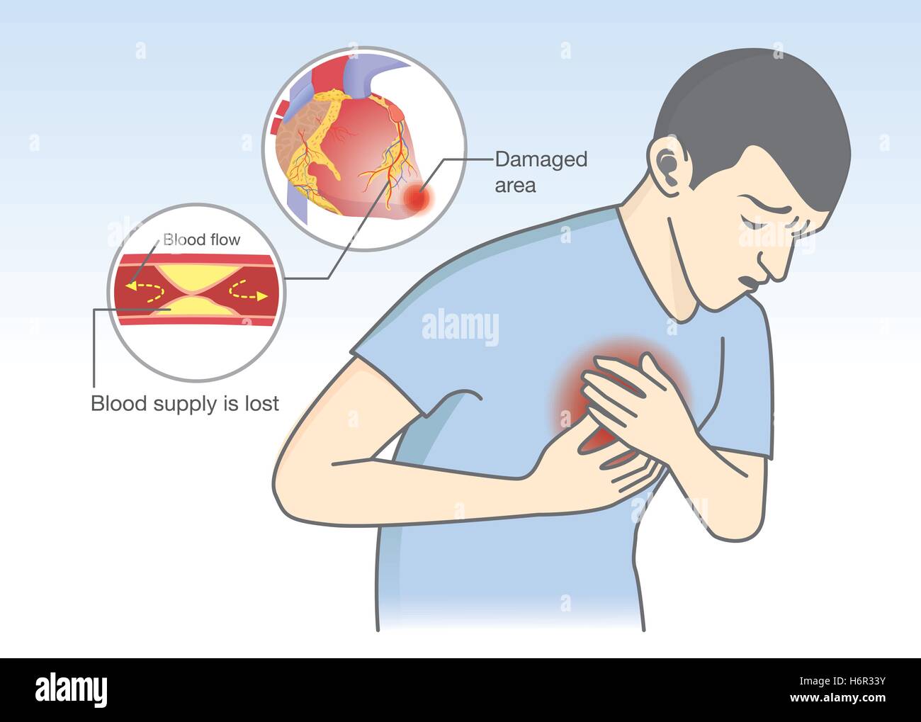Cause of heart attack symptoms from blood flow get blocked Stock Vector