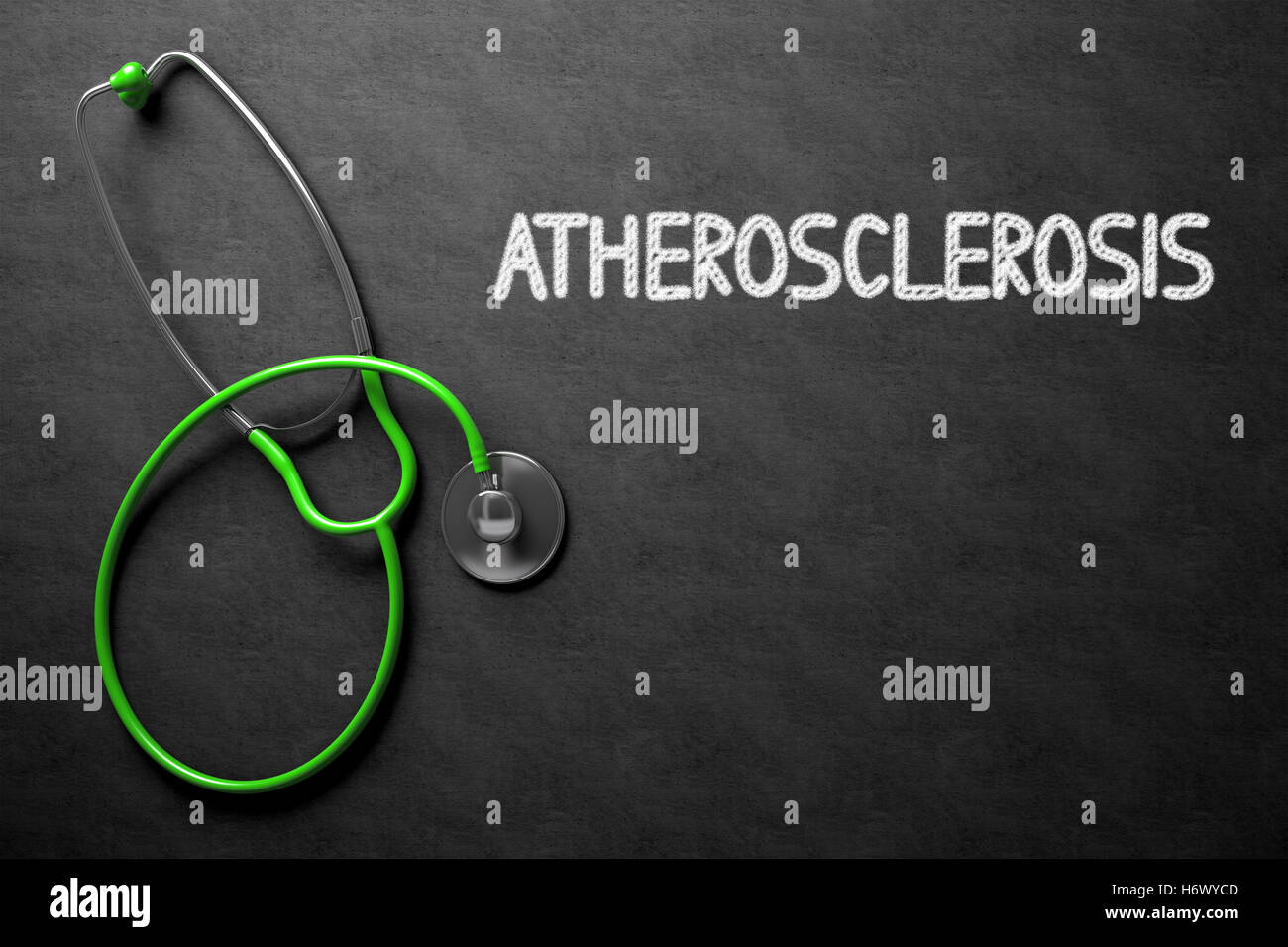 Atherosclerosis Handwritten on Chalkboard. 3D Illustration. Stock Photo