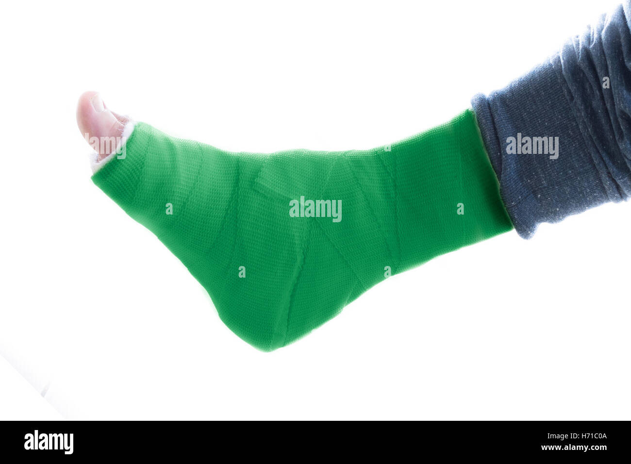 White plaster fiberglass leg cast hires stock photography and images