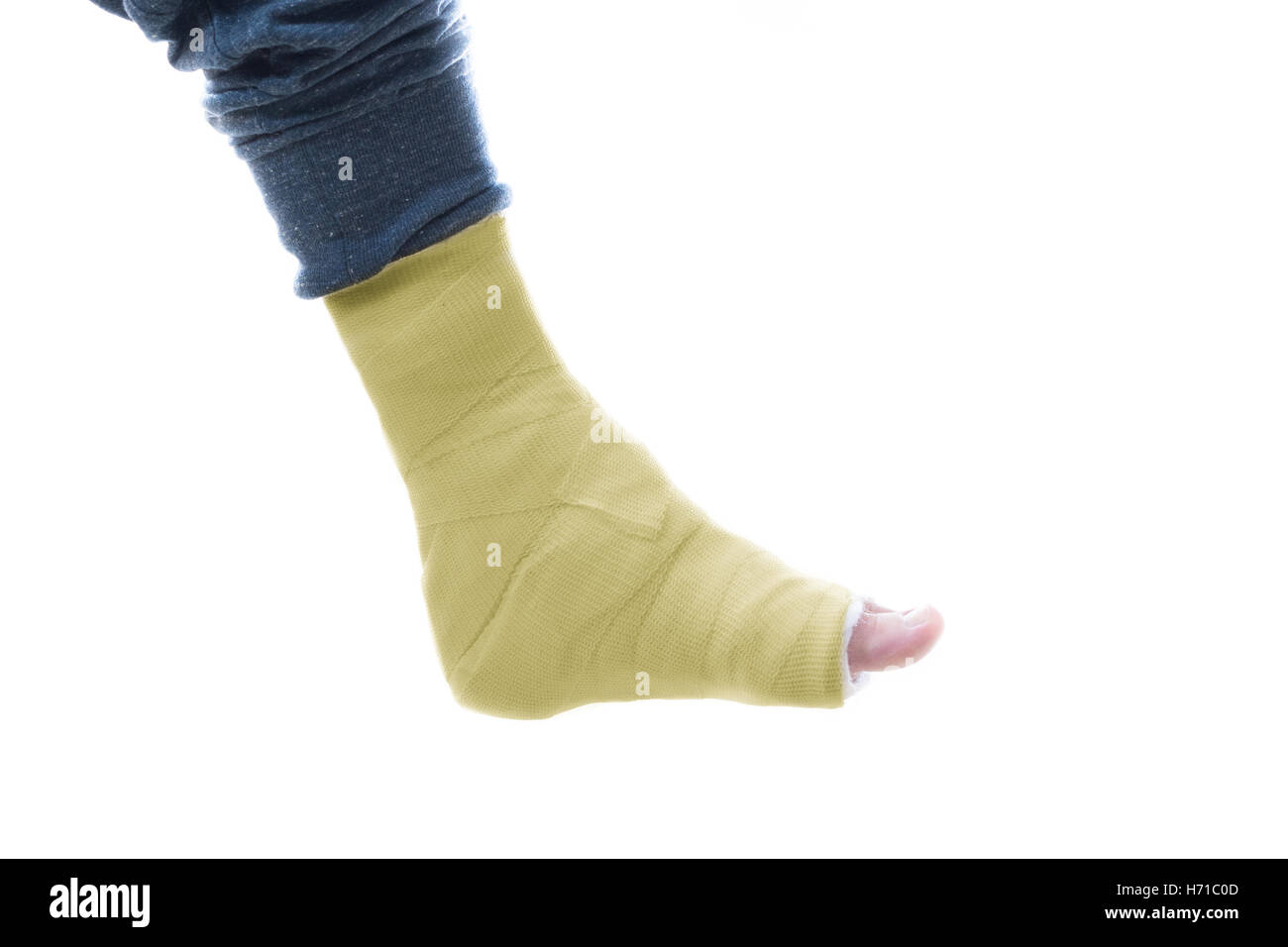 Yellow fiberglass and plaster leg cast worn by a young man (isolated on  white Stock Photo - Alamy