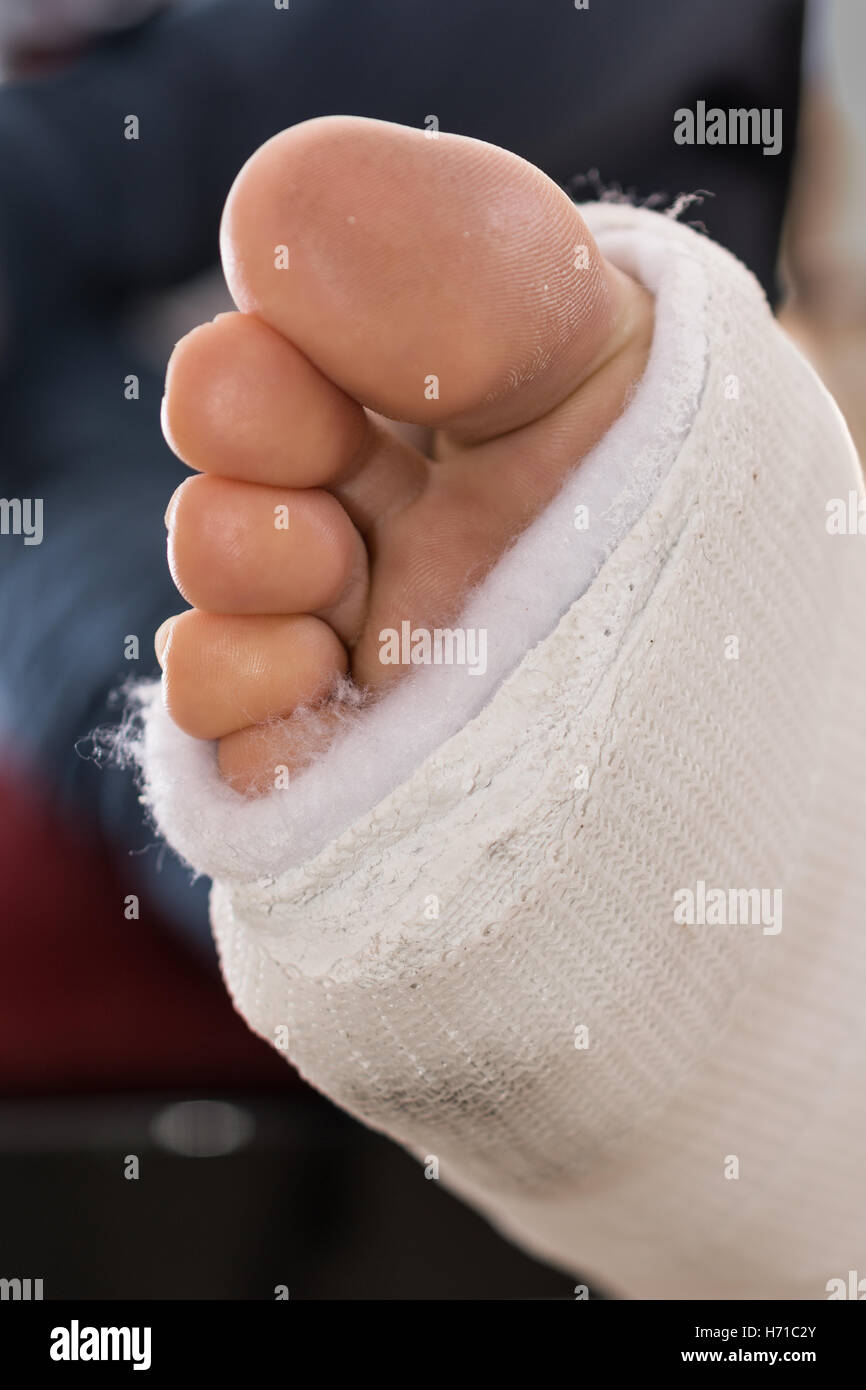Close up of a fiberglass / plaster leg cast and toes Stock Photo