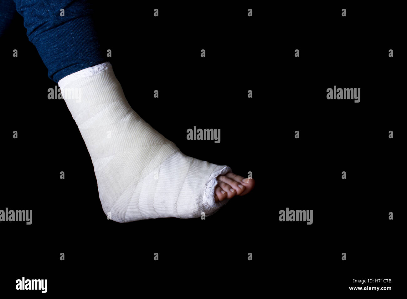 White plaster and fiberglass leg cast worn by a young man(isolated on black Stock Photo Alamy