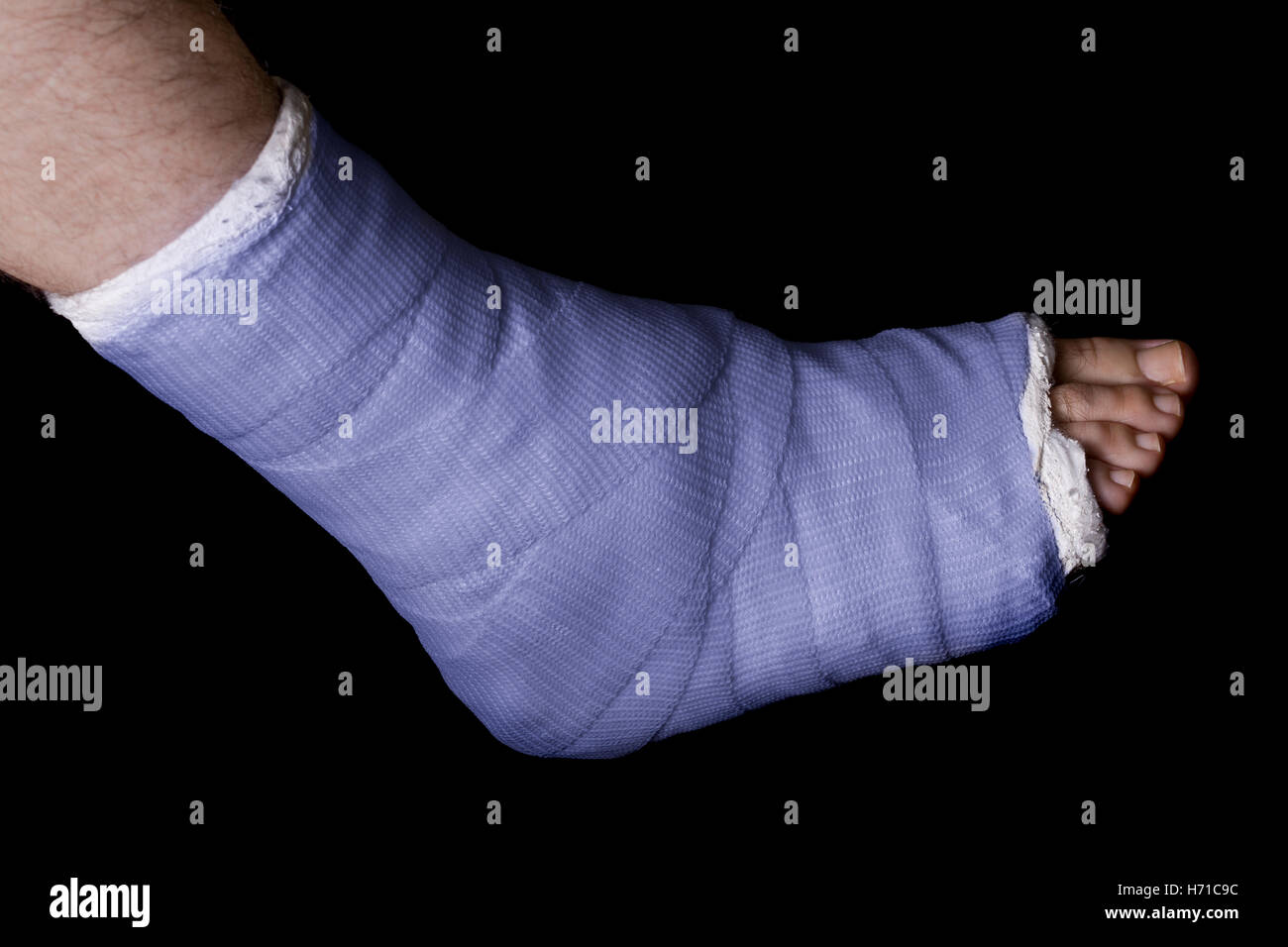 Blue plaster and fiberglass leg cast worn by a young man(isolated on