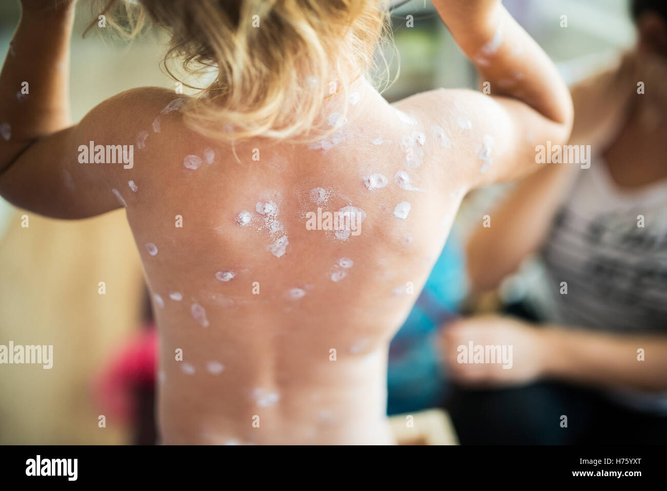 Back of little girl with chickenpox. Rear view. Stock Photo