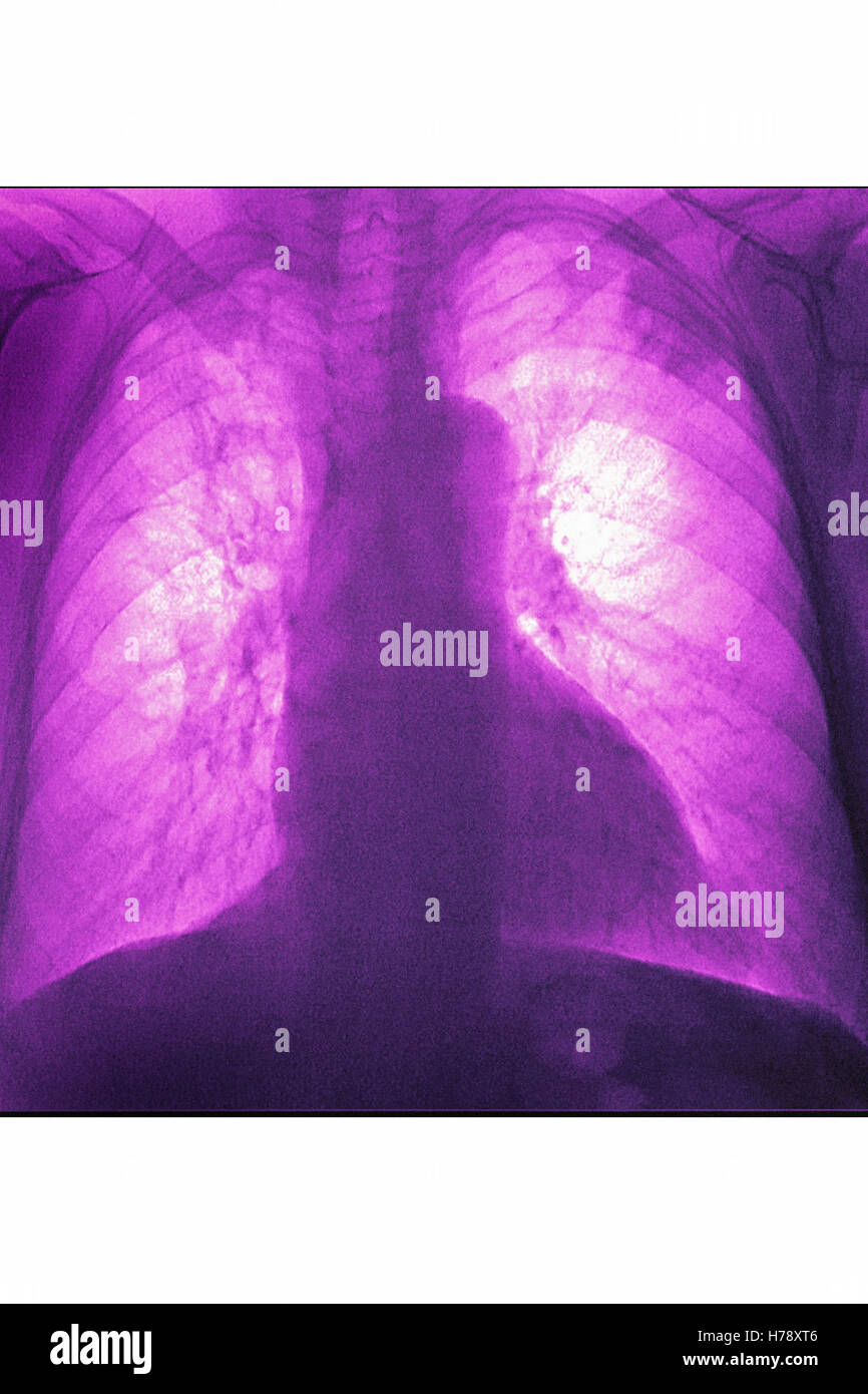 xray pneumonia xray pneumonia