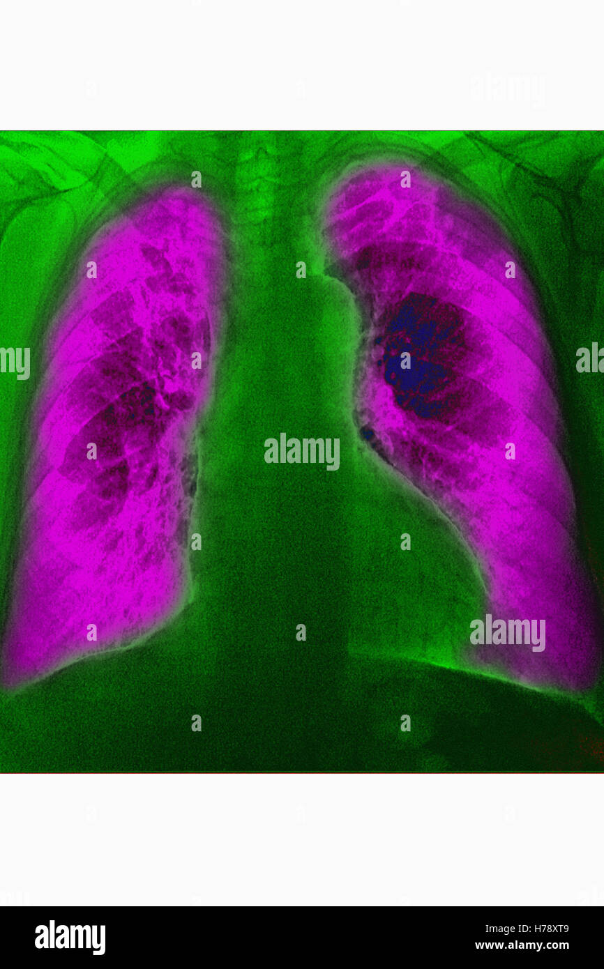 PNEUMONIA, XRAY Stock Photo Alamy