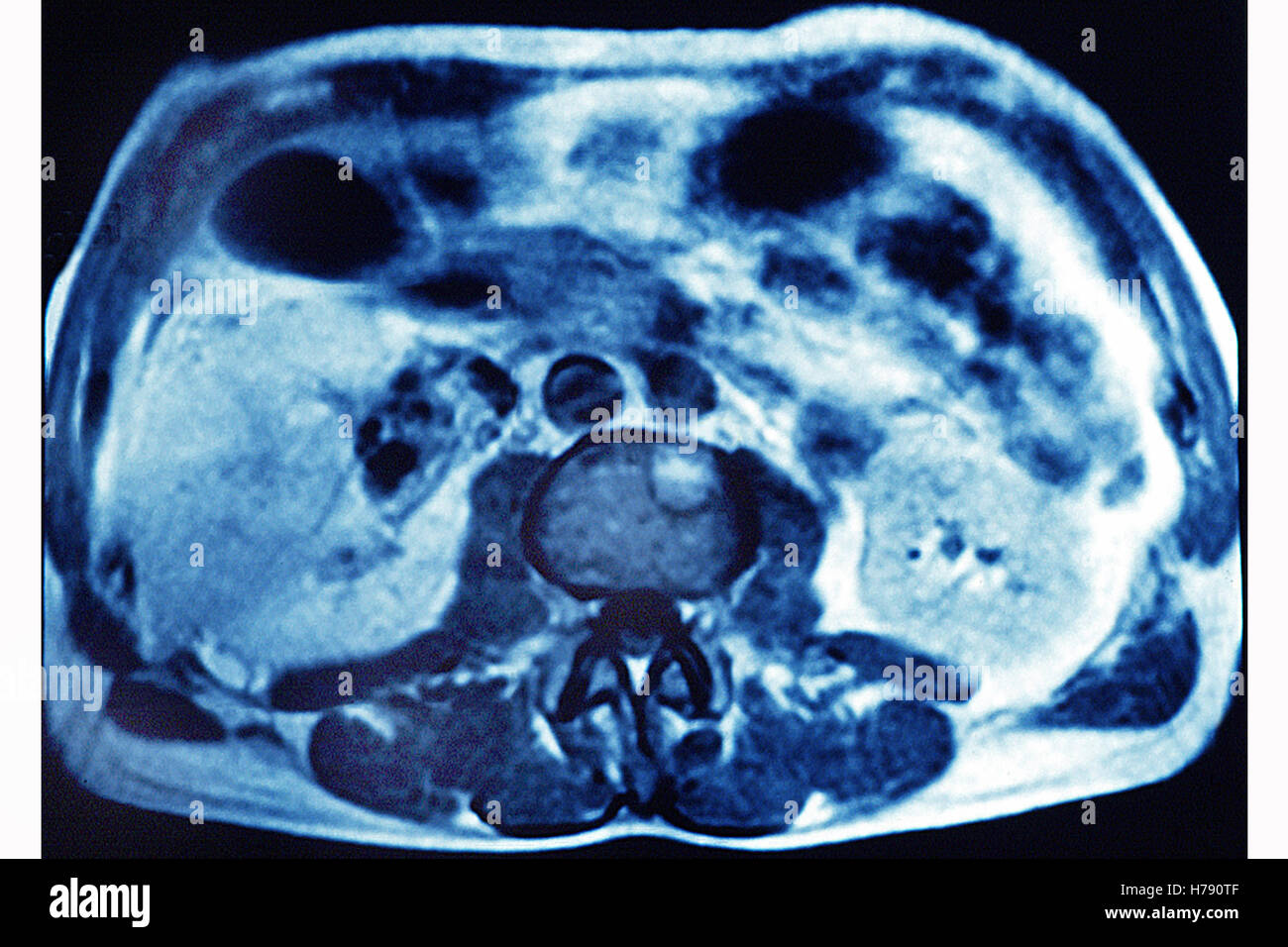 LIVER CANCER, SCAN Stock Photo