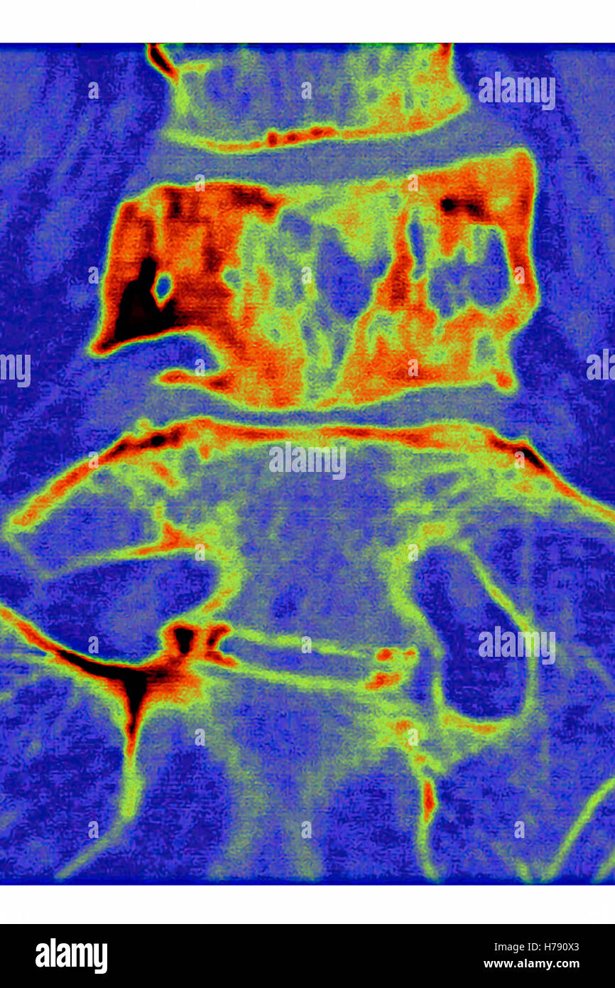 PAGET'S DISEASE, MRI Stock Photo Alamy