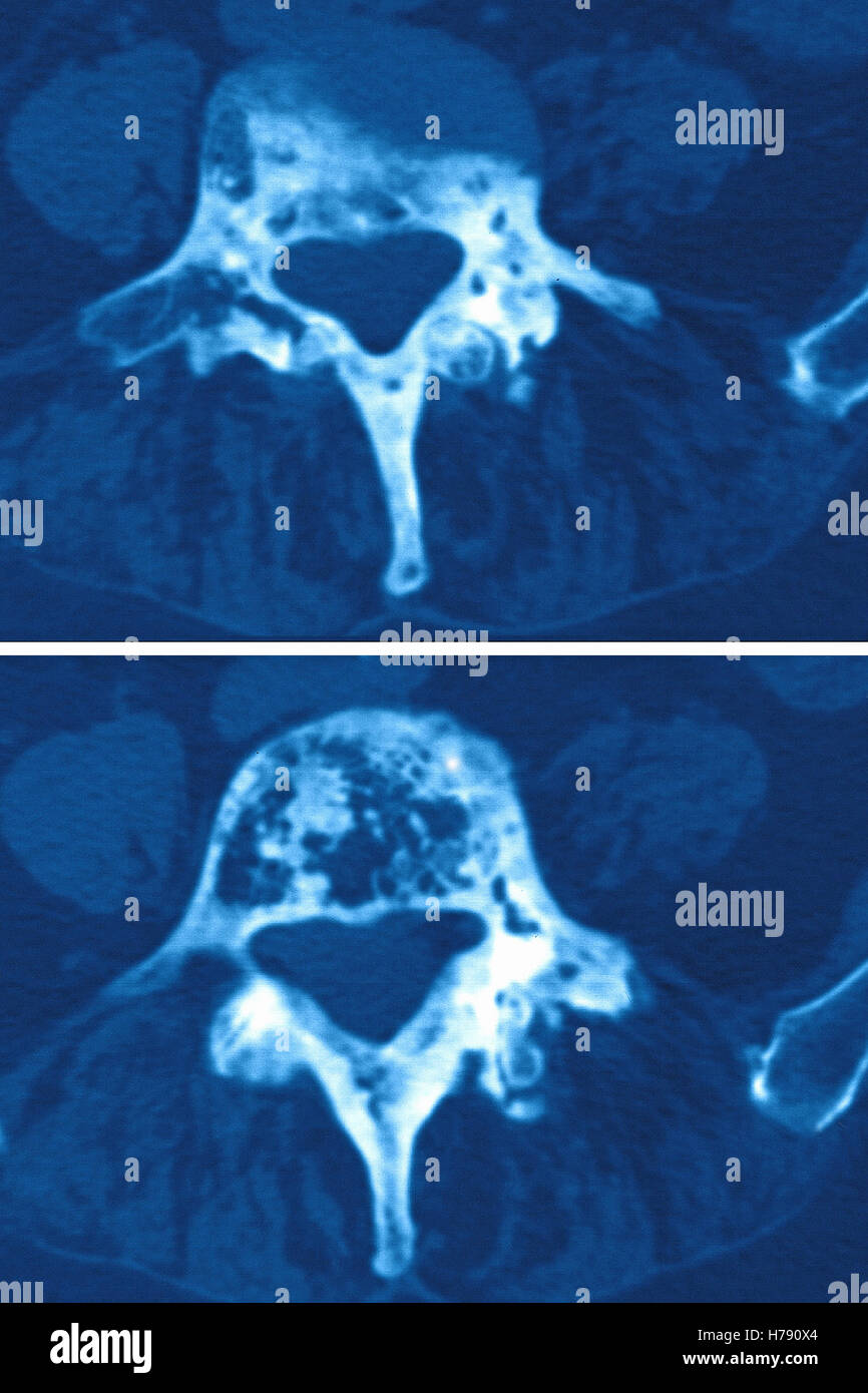 PAGET'S DISEASE, MRI Stock Photo Alamy