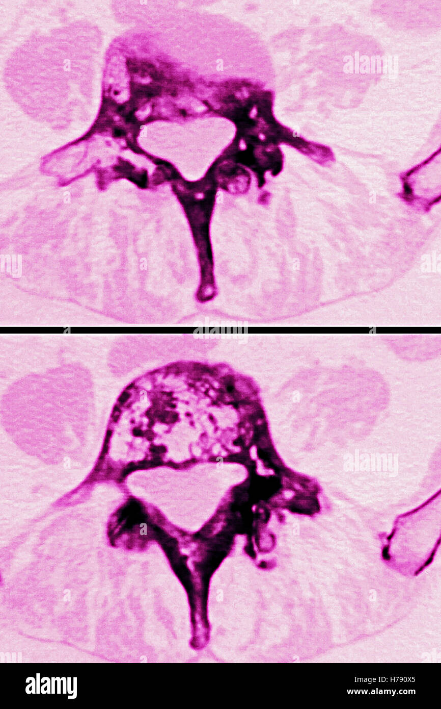 Pagets Disease High Resolution Stock Photography and Images Alamy