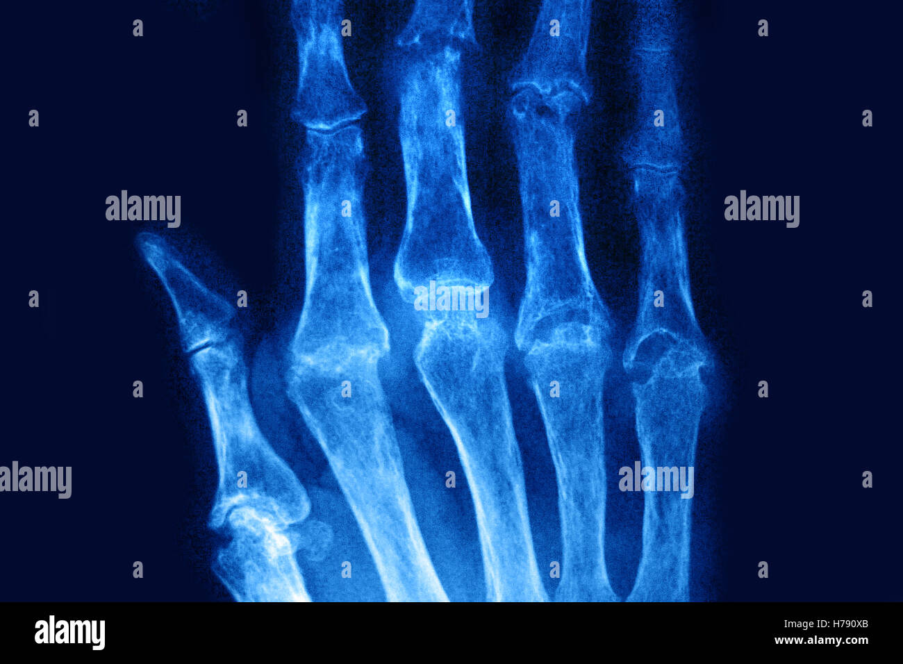 RHEUMATOID ARTHRITIS, X-RAY Stock Photo