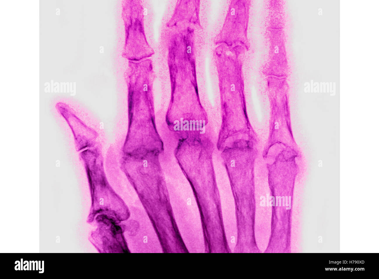 RHEUMATOID ARTHRITIS, X-RAY Stock Photo
