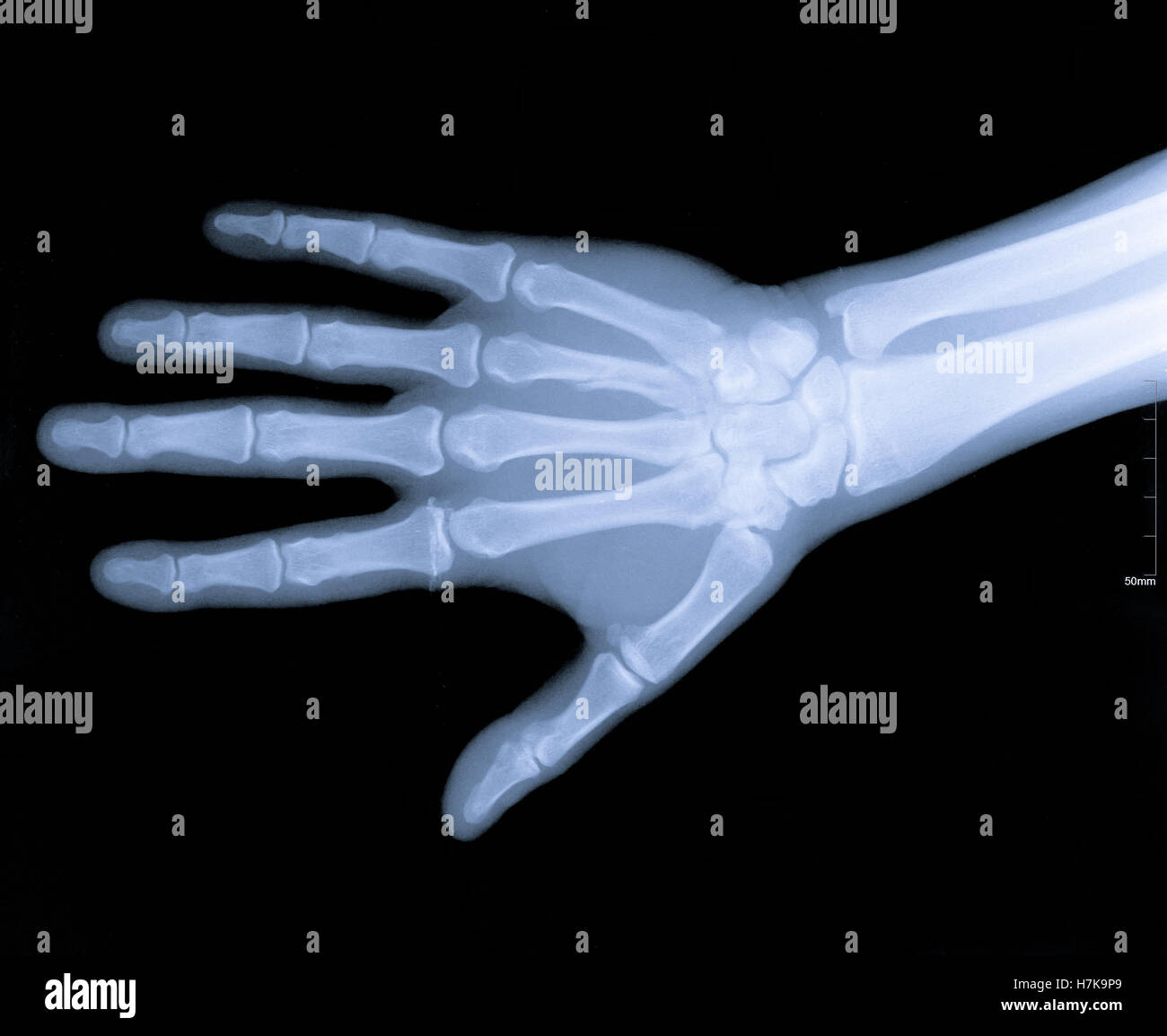 Xray image of human arms Stock Photo Alamy
