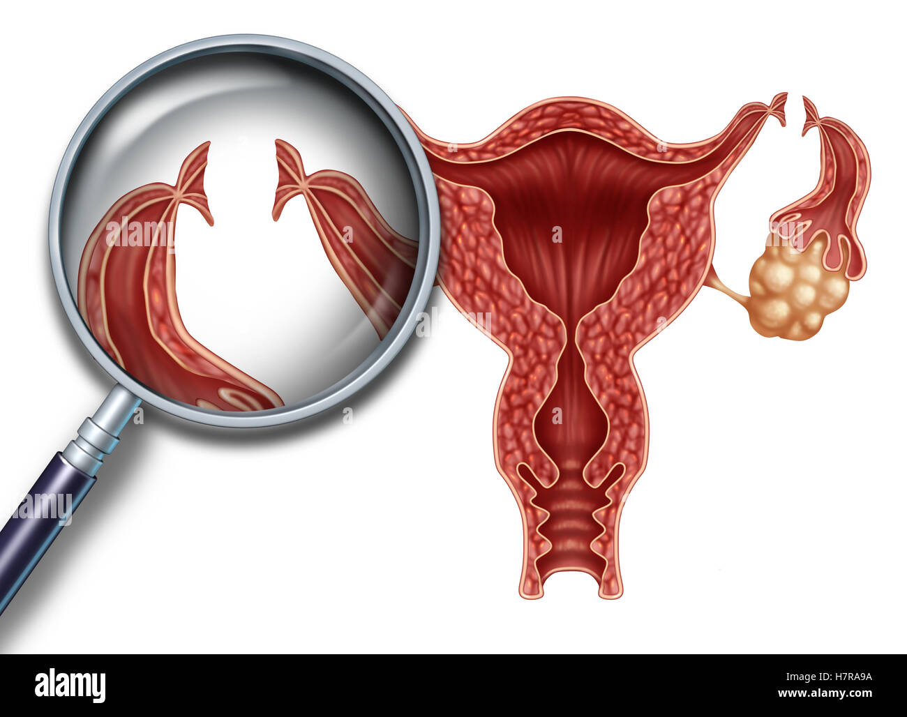 Tubal ligation reproduction medical procedure for female sterilization as a uterus with incisions on the fallopian tubes to block the egg from being fertilized as a fertility and gynecology medicine concept with 3D illustration elements. Stock Photo