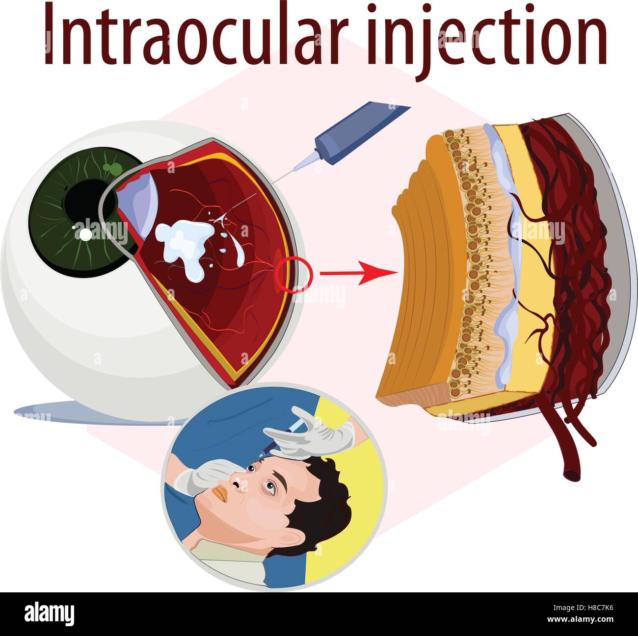 Vector illustration of intraocular injection. Stock Vector