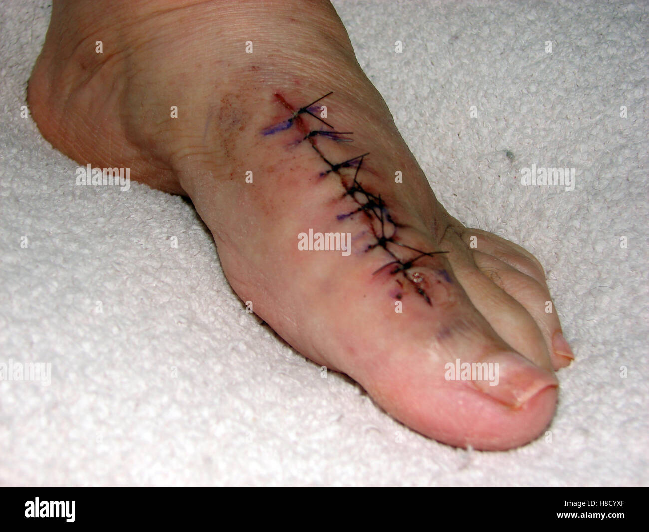 Incision and stitches on a foot after removing the medical appliances from a failed Bunion Surgery Stock Photo