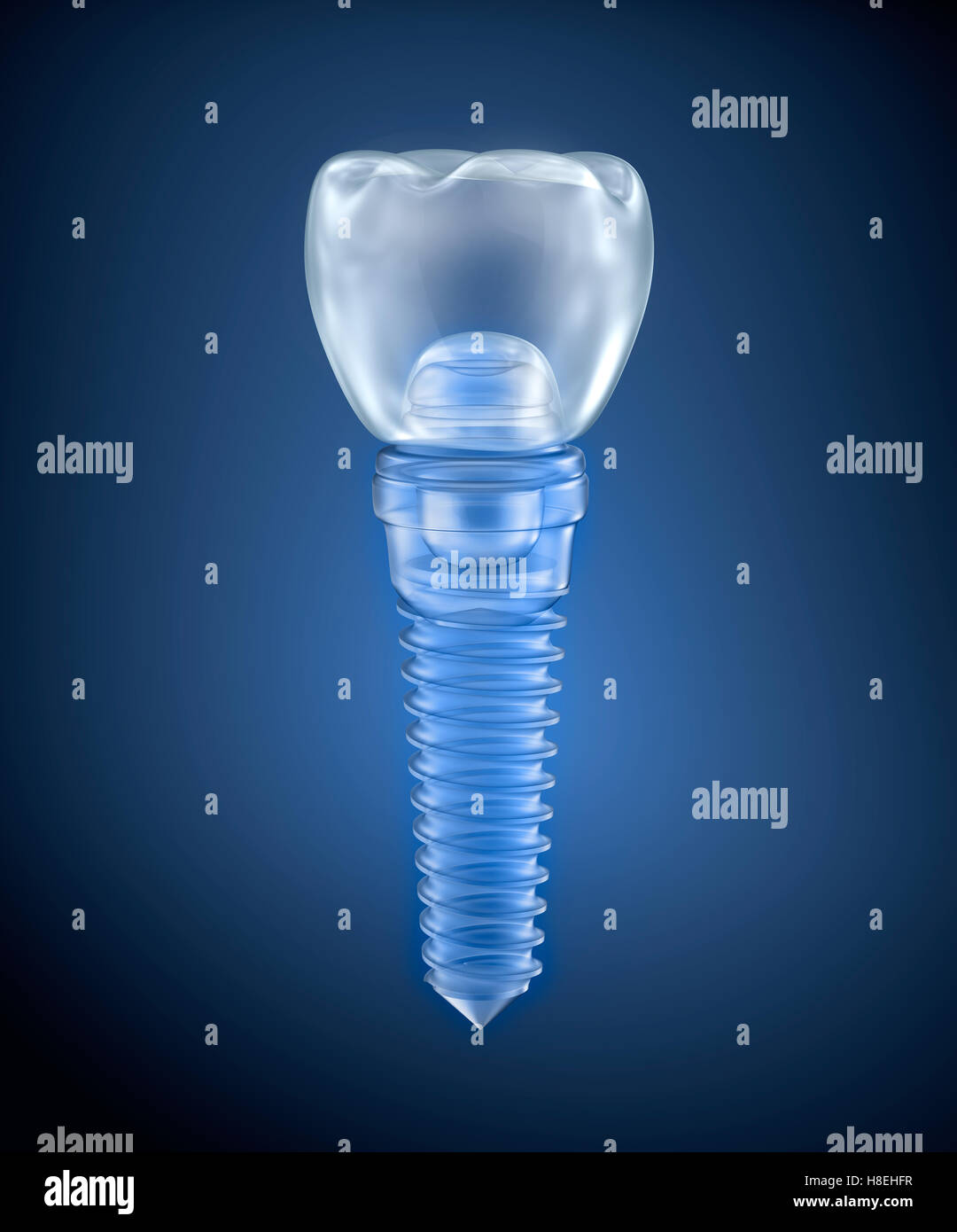 Dental titanium implant, xray view Stock Photo Alamy
