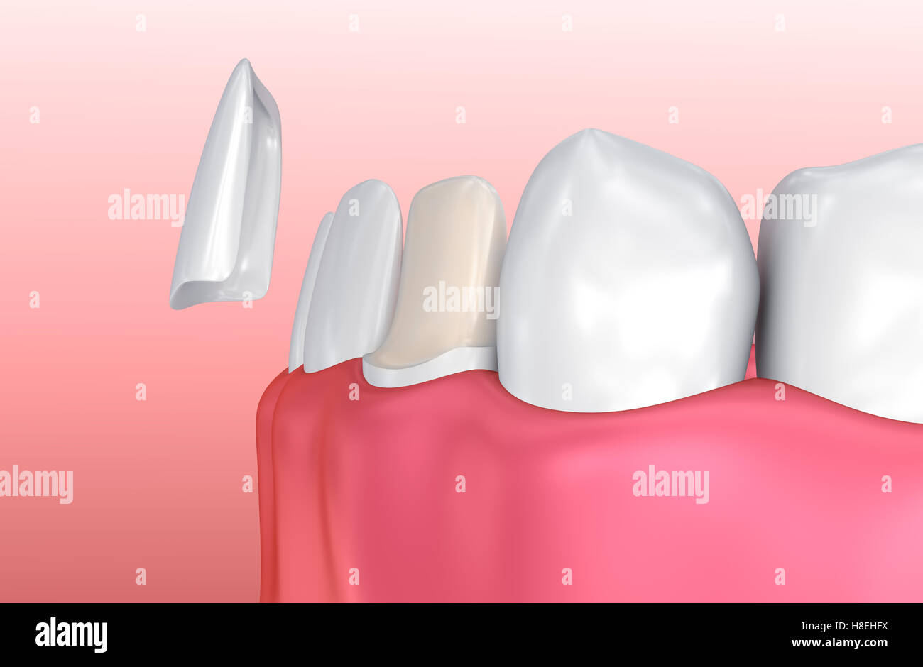 Dental veneers, illustration Stock Photo - Alamy