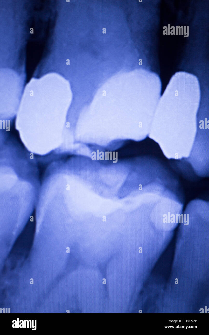 Dentists dental teeth xray showing tooth fillings Stock Photo Alamy