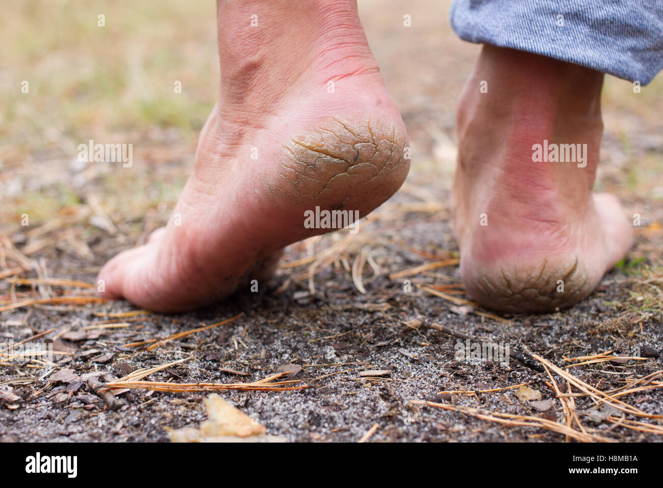 Close up photo pair of cracked heels. Male back view. Stock Photo