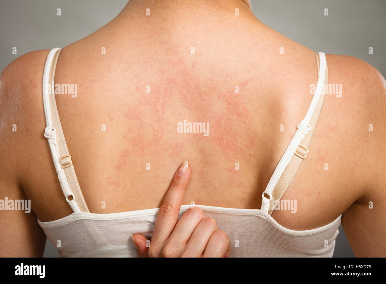 Health problem, skin diseases. Young woman showing her itchy back