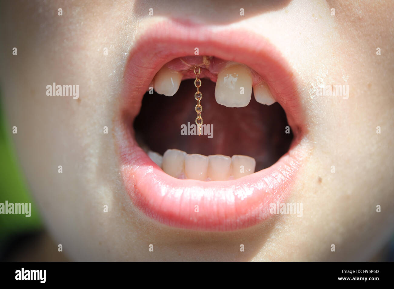 A young boy after having a chain fitted in surgery on tooth to attach to a  brace which will pull down tooth Stock Photo - Alamy