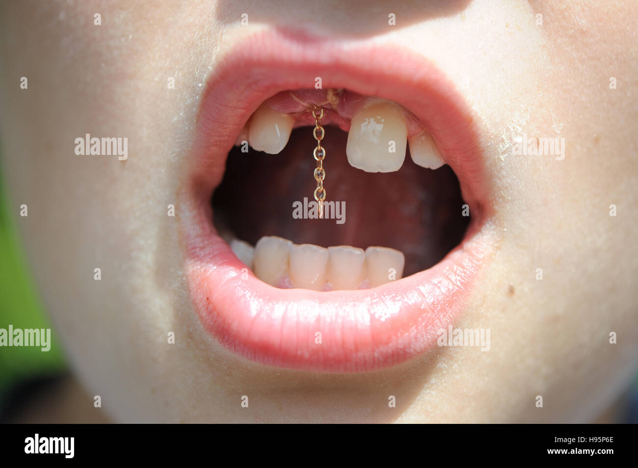 A young boy after having a chain fitted in surgery on tooth to attach