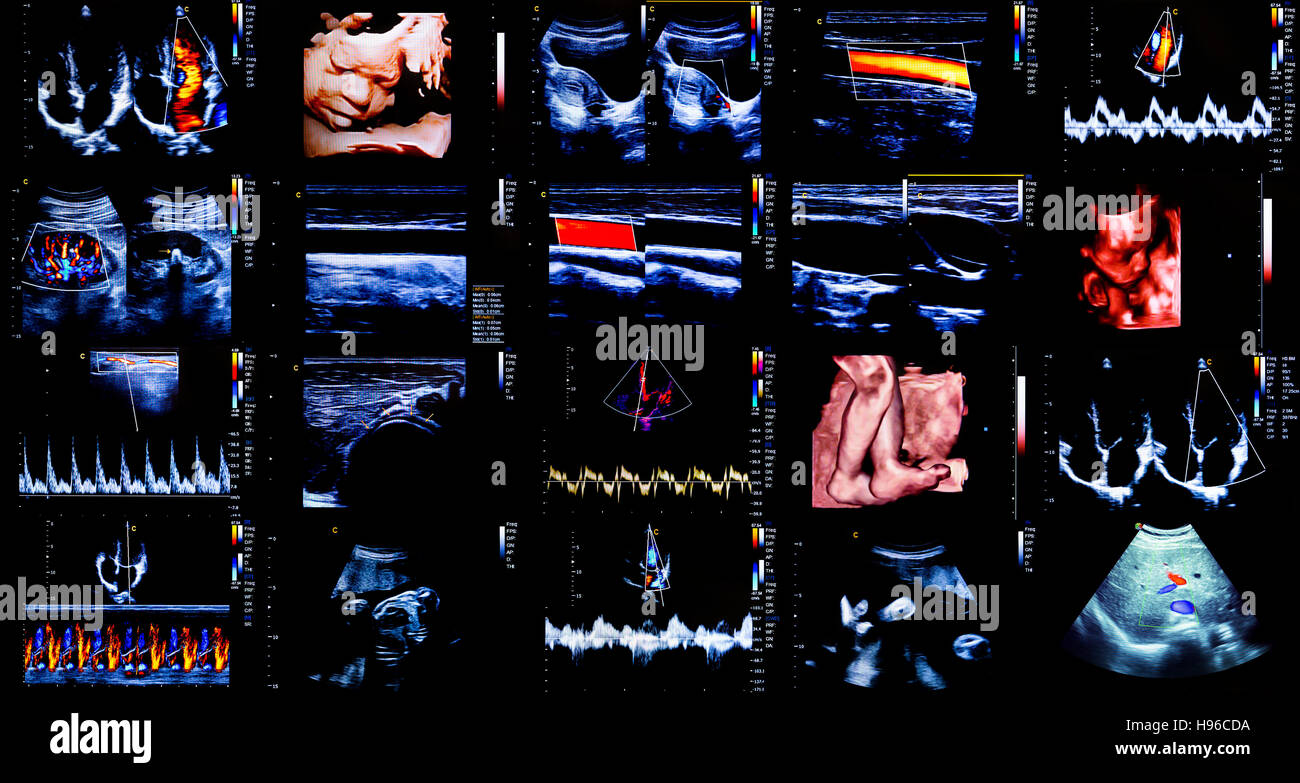 Compilation of 20 modern echocardiography (ultrasound) machine monitor colour images. New hospital equipment for a better diagnostics. Baby head, legs Stock Photo