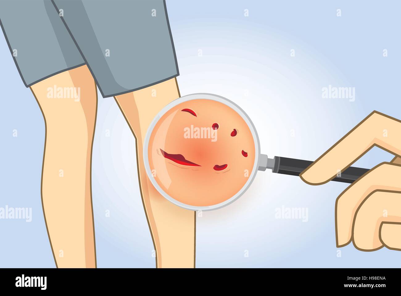 Zoom in dog bite wounds at leg. Stock Vector