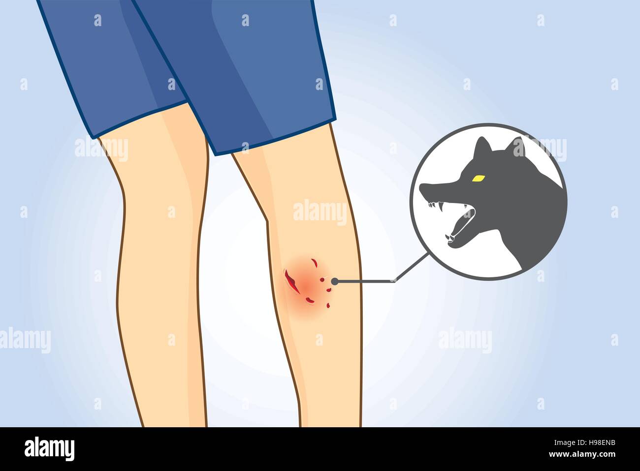 Dog bite wounds on calf leg Stock Vector Image & Art - Alamy