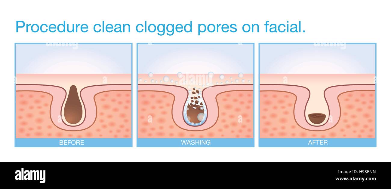 Procedure clean clogged pores on facial. Stock Vector