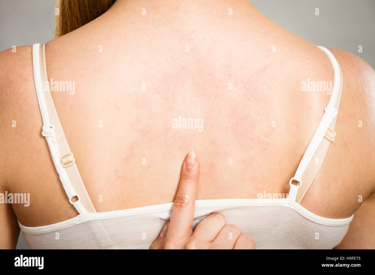 Health problem, skin diseases. Young woman showing her itchy back with  allergy rash urticaria symptoms Stock Photo - Alamy