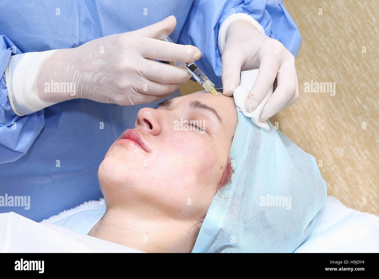 Bio-revitalization with hyaluronic acid treatment of mimic wrinkles Stock Photo