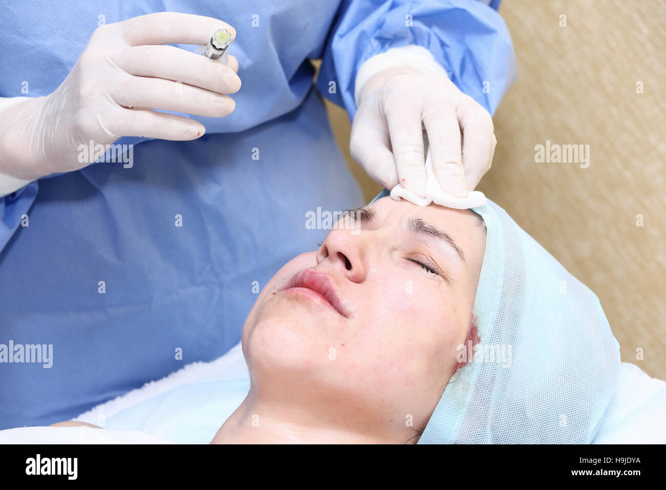 Bio-revitalization with hyaluronic acid treatment of mimic wrinkles Stock Photo