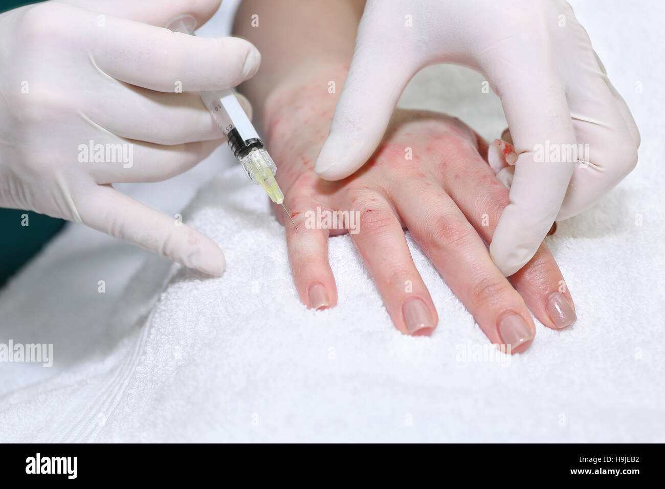 Anti-age injection therapy. Hand rejuvenation Stock Photo