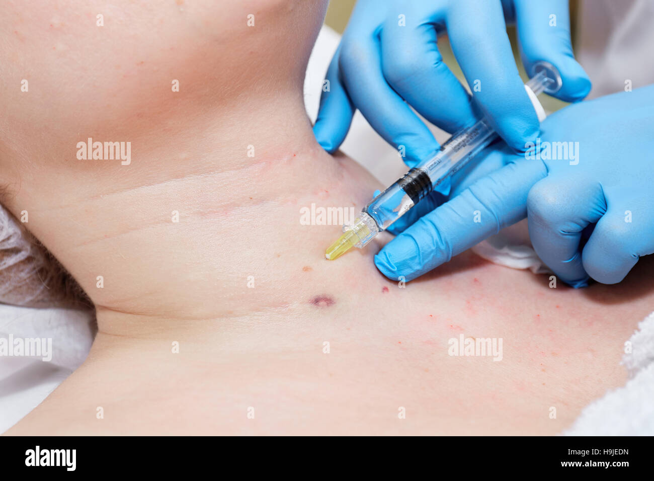 Anti-age injection therapy. Wrinkles reduction Stock Photo