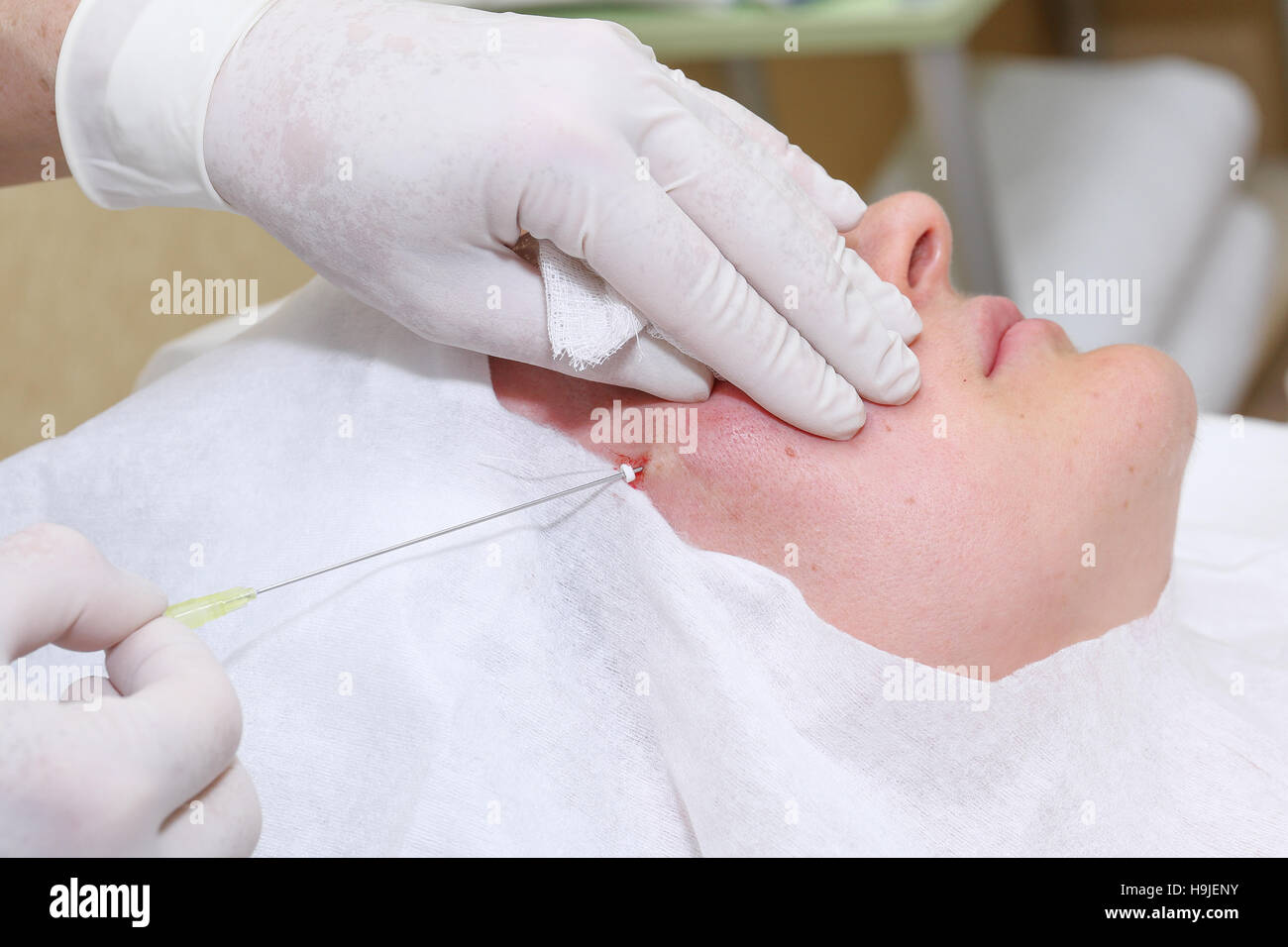 Procedure of face lifting surgery Stock Photo Alamy